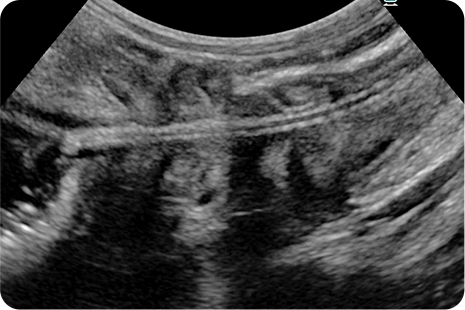 1‐a　胃-十二指腸の超音波検査(紐状異物)