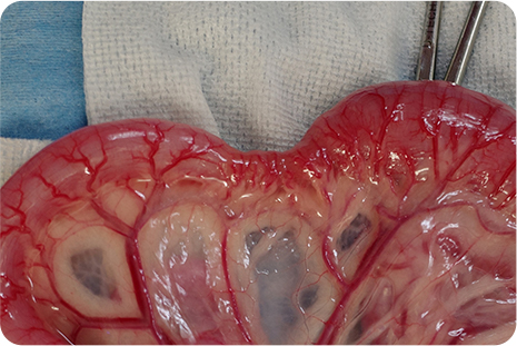 2　異物に起因した潰瘍・線維化を伴う腸炎