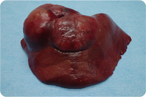 3‐b　切除した肝臓の外側左葉